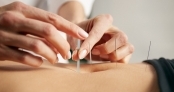 Health treatment with acupuncture